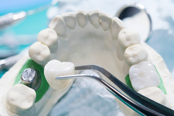 Questions To Ask A Dentist About Implant Crowns